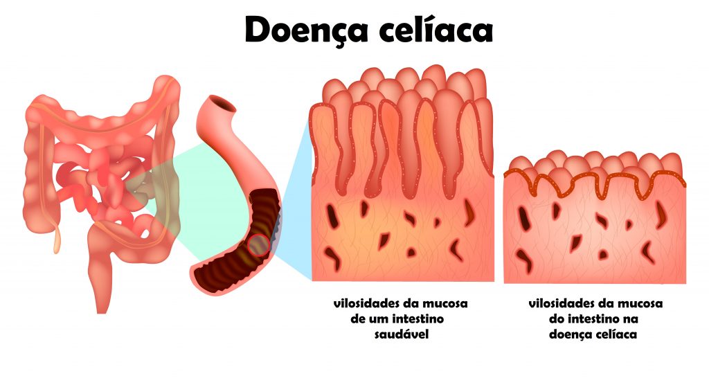 Doença celíaca e intestino