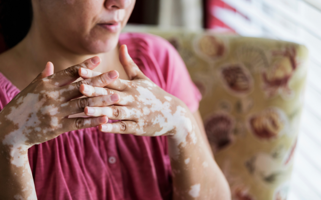 Vitiligo: o que você precisa saber sobre essa doença?